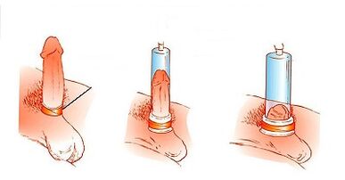 Principio de funcionamiento de una bomba para agrandar el pene.